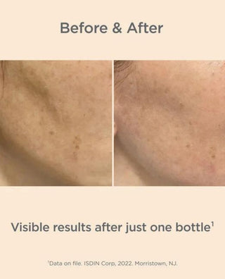 Melaclear Advanced Serum for dark spot removal before and after results