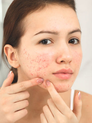 Read the Skin Devotee Facial guide to managing acne-prone and congested skin