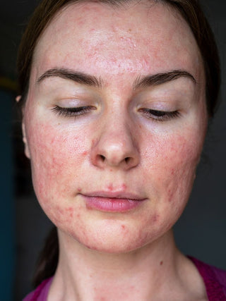 Skin Devotee Facial Studio expert guide to managing acne-prone and congested skin