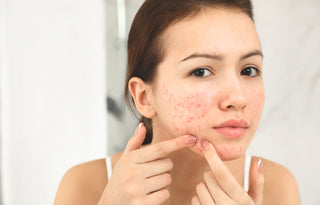 Read the Skin Devotee Facial guide to managing acne-prone and congested skin