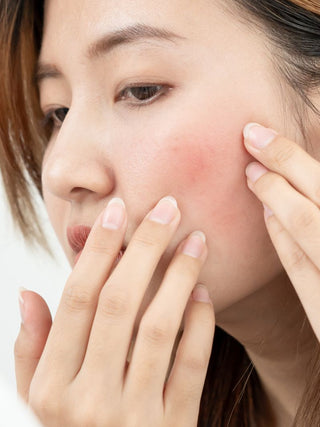 Read the Skin Devotee Facial Studio Guide to managing Redness and Sensitive skin