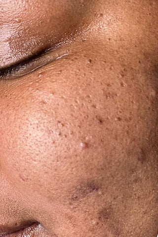 Skin Devotee Facial Studio before using BioRePeel treatment for acne scarring