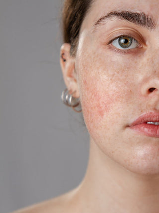 Read the Skin Devotee Facial Studio guide to managing Redness and Sensitive skin